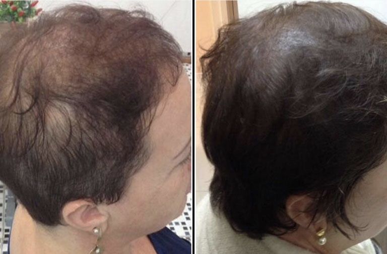 Antes e depois - Juliana, 52 anos: Achei que só um produto físico resolveria, mas depois de ler o método Raiz Bela, comecei a aplicar as receitas e técnicas. Em menos de um mês, meu cabelo começou a nascer mais forte e com brilho. Maravilhoso!